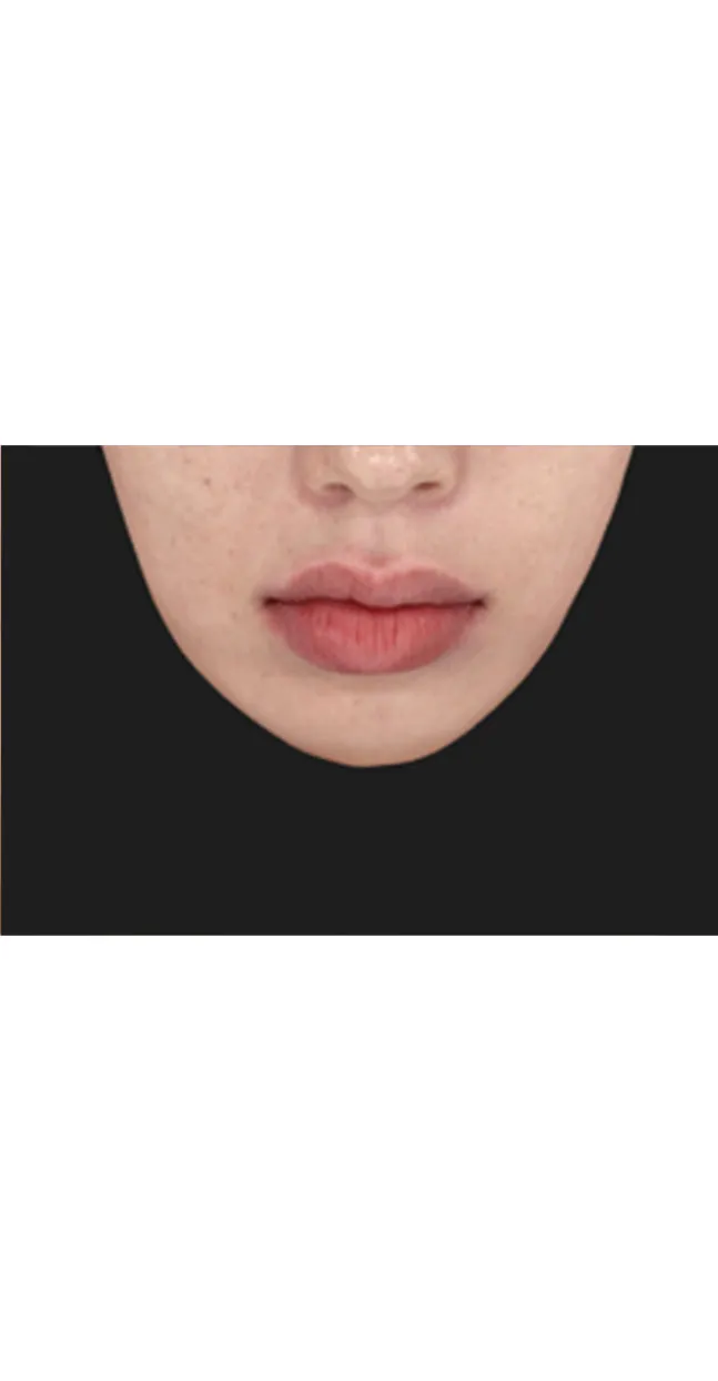 Peony Lip (입술필러)